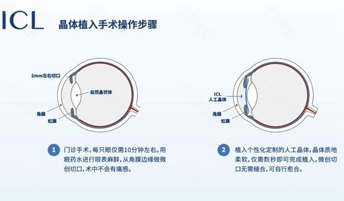近视人工晶体植入价格详解，费用、要点及注意事项全解析